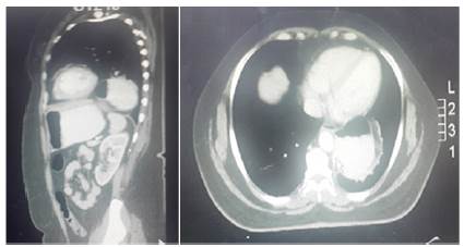 Tomografía. Obsérvese las relaciones anatómicas de la porción torácica del estómago