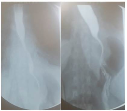 Radiografía control. Se observa normalidad del tránsito esofágico.