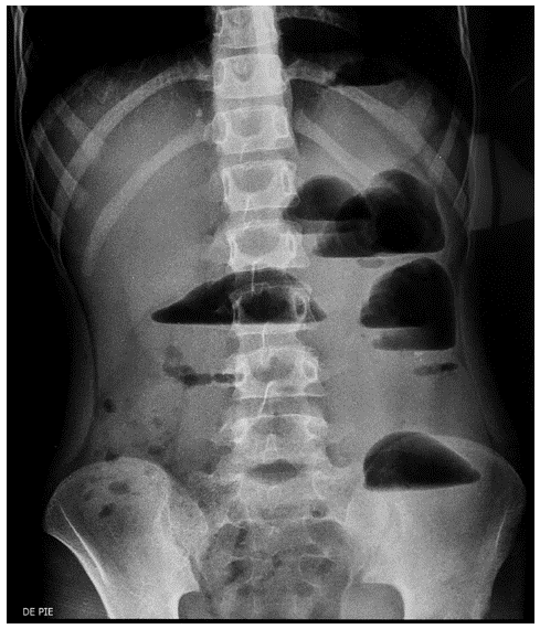 Radiografía de abdomen. Niveles hidroaéreos.