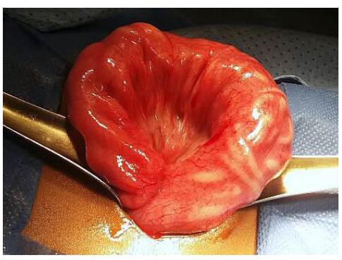 Apelotonamiento de Áscaris en un segmento de íleon.