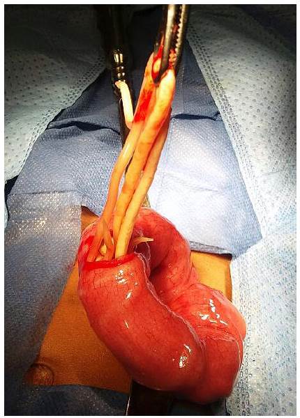 Enterotomía y retiro de parásitos.