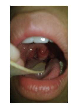 Apertura bucal. Aspecto externo del pólipo antrocoanal