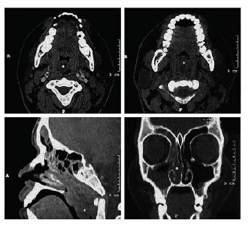 Aspecto tomográfico. El asterisco (*) indica la posición del pólipo