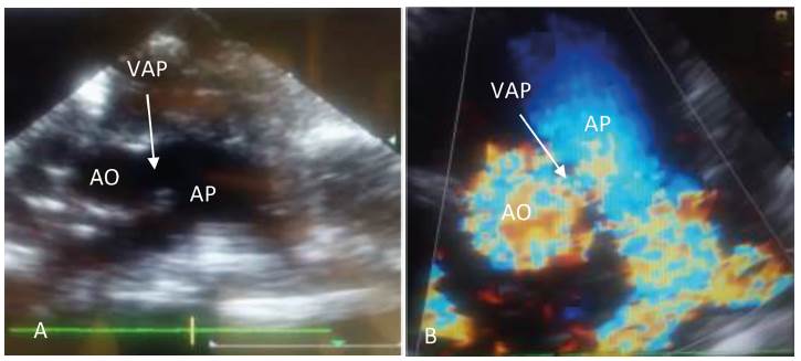 A. Ecocardiograma doppler bidimensional en plano paraesternal transversal de grandes vasos. B. VAP tipo I. AO: Arteria aorta. AP Arteria pulmonar