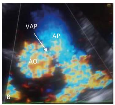 A. Ecocardiograma doppler bidimensional en plano paraesternal transversal de grandes vasos. B. VAP tipo I. AO: Arteria aorta. AP Arteria pulmonar. VAP: ventana aortopulmonar