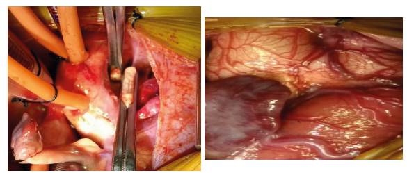 Vista quir&uacute;rgica VAP tipo I.