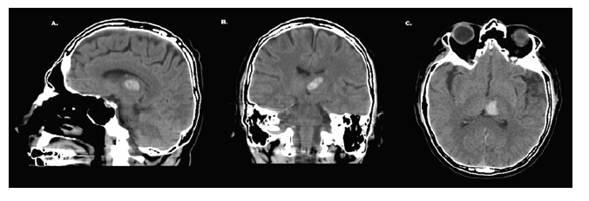 A, B y C: TAC de cráneo simple (corte sagital, coronal y axial) que evidencia hematoma de ubicación talámico izquierdo con diámetro máximo de 16 x 15 mm que estaría en relación a hematoma intraparenquimatoso