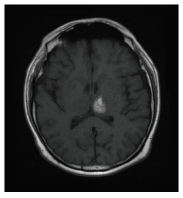 Corte axial de RMN cerebral contrastada, secuencia TI, que evidencia imagen con cambios en la señal presentando hiperintensidad, de ubicación talámica izquierda, de evolución subaguda precoz (4-7 días)
