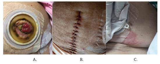 A. Estoma intestinal (colostomía). B. Herida quirúrgica. C. Lesión en la zona periostomal.