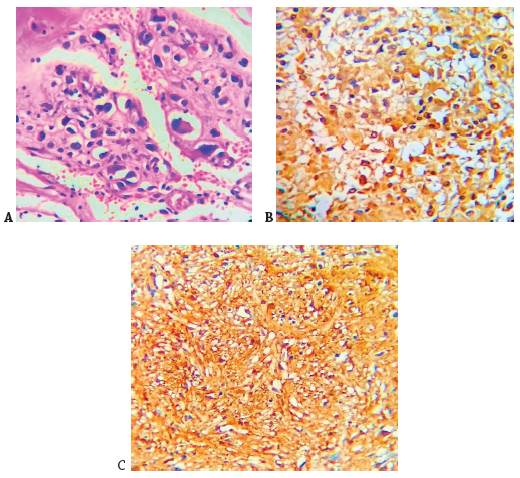 (A) En la tinci&oacute;n de hematoxilina y eosina (H&E) se observa c&eacute;lulas tumorales que invaden la l&aacute;mina propia y la ulceraci&oacute;n de la mucosa. N&oacute;tese ampliaci&oacute;n a 40X. (B) En la tinci&oacute;n de Inmunohistoqu&iacute;mica hay expresi&oacute;n intensa para CD117. Las c&eacute;lulas tumorales son positivas para c-KIT. (C) El marcador DOG-1 es fuertemente positivo para las c&eacute;lulas tumorales difusas.