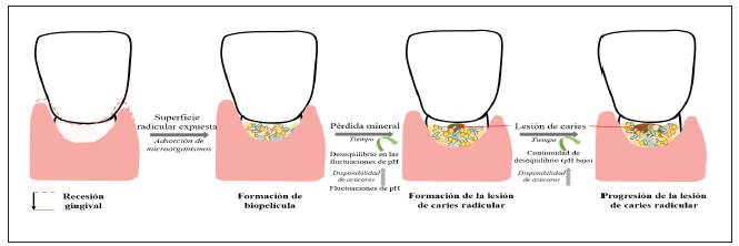 Proceso de caries radicular. Esquema del proceso de formaci&oacute;n de la lesi&oacute;n de caries radicular: recesi&oacute;n gingival, formaci&oacute;n de biopel&iacute;cula en la superficie radicular expuesta, formaci&oacute;n de la lesi&oacute;n de caries por disbiosis en la biopel&iacute;cula y progresi&oacute;n de la lesi&oacute;n de perpetuarse las condiciones acidog&eacute;nica y acid&uacute;rica de la biopel&iacute;cula