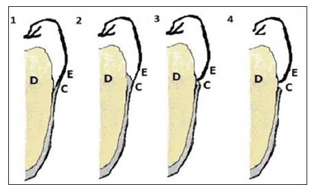 Esquema de la conformaci&oacute;n de la Uni&oacute;n Cemento-Esmalte (UCE). La figura muestra la relaci&oacute;n entre el cemento y el esmalte en la UCE de acuerdo con la clasificaci&oacute;n de Choquet 1989. E: esmalte, C: cemento, D: dentina