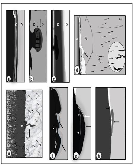 Patrones de caries radicular en diferentes estadios de severidad. La figura muestra, de forma esquem&aacute;tica, patrones de lesiones de caries radicular en diferentes estados de severidad. Patr&oacute;n de lesiones iniciales de cemento radicular: uniforme de p&eacute;rdida mineral (a), con forma de halo (flechas largas superiores) y proyecciones radiales hacia el interior del tejido (cabeza de flecha) (b) y microcavidad superficial con desmine-ralizaci&oacute;n en forma de halo de desmineralizaci&oacute;n subsuperficial (c). Patr&oacute;n de lesiones iniciales de dentina: desmineralizaci&oacute;n escalonada de la dentina expuesta cubierta por microorganismos que contienen una zona de desmineralizaci&oacute;n avanzada -A1- que se extiende a un &aacute;rea menos desmineralizada -A2- con un &aacute;rea adyacente a&uacute;n mineralizada -AS- (d) y representaci&oacute;n de microhendiduras (flecha) con invasi&oacute;n de microorganismos (e). Patrones de lesiones avanzadas de la dentina radicular (f y g): desmineralizaci&oacute;n multifocal de la dentina con capas mineralizadas en la superficie (puntas de flecha) y en las partes m&aacute;s profundas de la lesi&oacute;n (flechas). Caries radicular con superficie hipermineralizada y desmineralizaci&oacute;n subsuperficial (h).