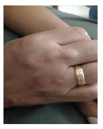 Xantomas tendinosos en extensores de segundo, tercero y cuarto dedo