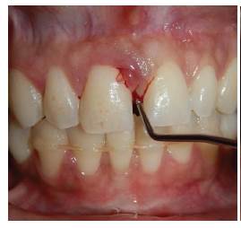 Lesión tumoral ubicada en encía Marginal por mesial de órgano dental 11