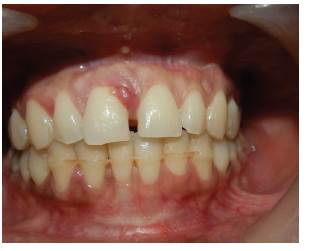 Sondaje periodontal que muestra una profundidad de sondeo de 10 mm