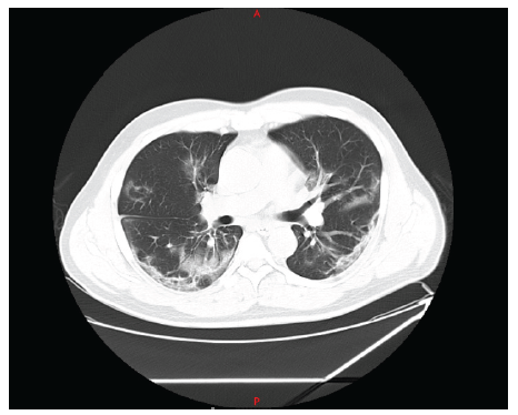 Computed chest tomography scan on admission (11/24/2020)