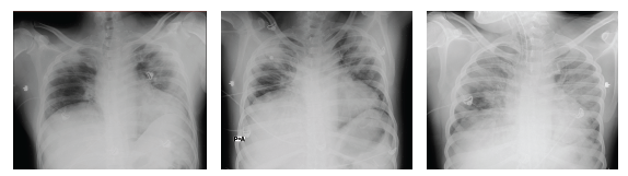 Chest X-rays evolution from admission to 11/28/2020