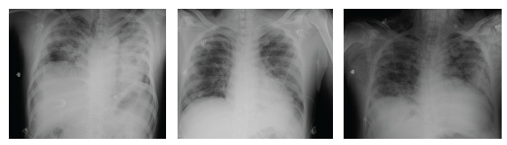 Evolution x-ray mechanical ventilation from 28/11/2020 to extubation on 10/12/2020.