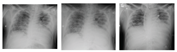 X-ray evolution from tracheotomy to hospital discharge on 01/14/2021.