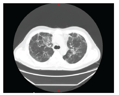 Post covid computed chest tomography scan (01/23/2021)