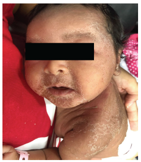 placas descamativas en regi�n peri orbitaria y perioral