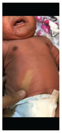 Eritema difuso que palidece a la digitopresi�n