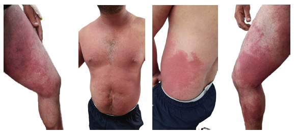 Lesiones eritematosas acompa�adas de ves�culas y placas en paciente con toxicidad asociada a Toxicodendrum striatum.