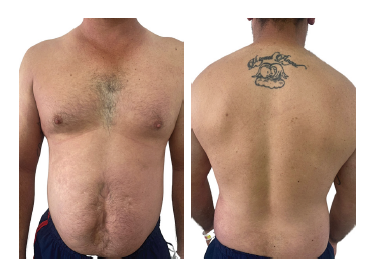 Evoluci�n de las lesiones posterior a 7 d�as de manejo multimodal. 
