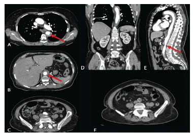 CT Angiography