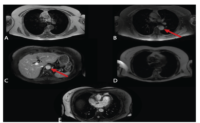 Magnetic Resonance Angiography (30 days after treatment)