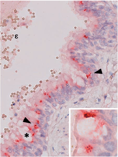 Ant�genos del virus de influenza A
H1N1/v09 en c�lulas infectadas de tejido pulmonar de un paciente fallecido por
la influenza, cuyo caso fue reportado en la pandemia de 2009 en Colombia.
