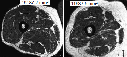 �rea de la secci�n transversal de masa
muscular del cu�driceps femoral de dos hombres; la figura de la izquierda corresponde
a un hombre que ejecut� 17 repeticiones en la prueba de sentarse y levantarse y
la figura de la derecha a otro que ejecut� 11 repeticiones en dicha prueba. 

 