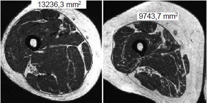 �rea de la secci�n transversal de masa
muscular del cu�driceps femoral de dos mujeres; la figura de la izquierda corresponde
a una mujer que ejecut� 19 repeticiones en la prueba de sentarse y levantarse y
la figura de la derecha a otra mujer que ejecut� diez repeticiones en dicha
prueba.