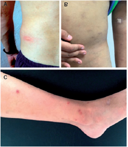 Lesiones típicas que se presentan en la urticaria papular. A. Roncha que aparece como reacción inmediata a la picadura de mosquito. B. Cicatrices hipercromáticas crónicas en el abdomen debidas a la picadura de mosquito C. Lesiones papulares en la extremidad inferior por picadura de pulga (reacción tardía).