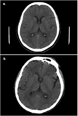 Comparaci&oacute;n de las TC simples de cr&aacute;neo de la paciente del caso 1. a. En la TC realizada en el momento de ingreso al hospital no se observaron alteraciones patol&oacute;gicas. b. &Uacute;ltima TC realizada en la instituci&oacute;n, en la cual se evidencia aumento de la amplitud de la cisura silviana y de los surcos corticales en forma difusa, con preservaci&oacute;n de las estructuras de la l&iacute;nea media (cortes&iacute;a de Vicente Aljure Reales).