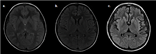 Resonancia magn&eacute;tica cerebral simple con serie de cortes axiales en secuencia FLAIR de la paciente del caso 2. a. Estudio realizado en el momento de su ingreso al hospital; no se observan alteraciones en el par&eacute;nquima cerebral. b. Estudio realizado cuatro meses despu&eacute;s de su ingreso; se aprecia p&eacute;rdida incipiente del volumen cerebral debida a un mayor crecimiento de los ventr&iacute;culos y a la ampliaci&oacute;n del tama&ntilde;o de los surcos cerebrales. c. Estudio realizado 11 meses despu&eacute;s del inicio de sus s&iacute;ntomas, en el cual se observa una p&eacute;rdida mucho mayor de volumen cerebral en comparaci&oacute;n con los anteriores.