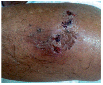 P&aacute;pulas y n&oacute;dulos exulcerados en el codo izquierdo