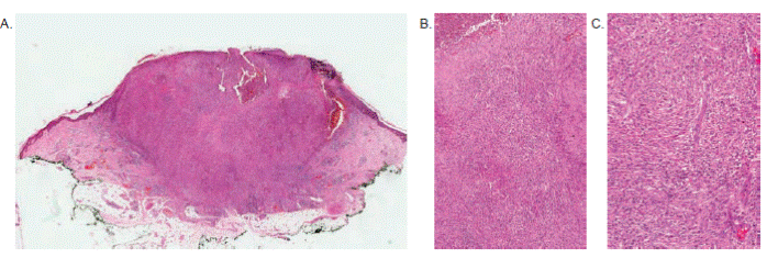 A. Imagen panor&aacute;mica que muestra una lesi&oacute;n intrad&eacute;rmica, bien circunscrita, con absceso central superficial y exulceraci&oacute;n. Hematoxilina y eosina, 2X. B. La lesi&oacute;n es hipercelular, con c&eacute;lulas fusiformes. Arriba, a la izquierda, se ve el componente abscedado. Hematoxilina y eosina, 10X. C. El componente fusiforme se acompa&ntilde;a de algunas c&eacute;lulas vacuoladas y de plasmocitos escasos, dispersos. Hematoxilina y eosina, 20X.