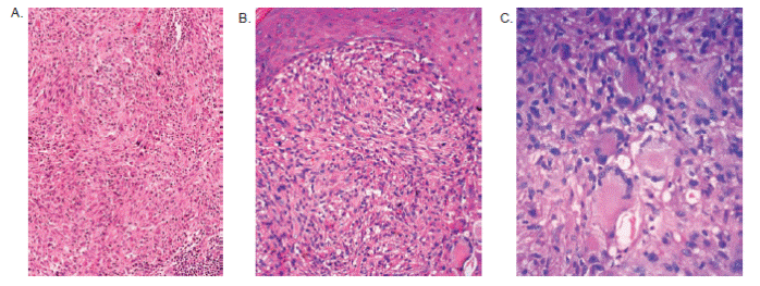 A. La lesi&oacute;n presenta tambi&eacute;n algunas c&eacute;lulas multinucleadas y conglomerados discretos de linfocitos (abajo, derecha). Hematoxilina y eosina, 20X. B. Este componente fusocelular subepid&eacute;rmico contiene pocas c&eacute;lulas gigantes de tipo Touton (abajo, derecha). Hematoxilina y eosina, 20X. C. Peque&ntilde;o grupo de c&eacute;lulas gigantes de tipo Touton. Hematoxilina y eosina, 40X.