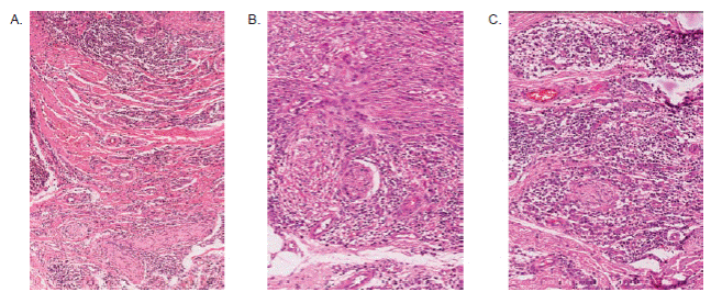 A. Fibrosis e inflamaci&oacute;n perineural linfoplasmocitaria en el l&iacute;mite profundo de la lesi&oacute;n. Hematoxilina y eosina, 12X. B. C&eacute;lulas fusiformes profundas y filete nervioso con perinervio mal definido, rodeado de importante infiltrado de plasmocitos y macr&oacute;fagos vacuolados. Hematoxilina y eosina, 20X. C. Inflamaci&oacute;n profunda, plasmocitaria, que rodea un filete nervioso. Hematoxilina y eosina, 20X.