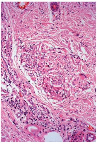 Granuloma de macr&oacute;fagos vacuolados, c&eacute;lulas epitelioides, algunas gigantes, linfocitos y plasmocitos, en los bordes laterales de la lesi&oacute;n. Hematoxilina y eosina, 20X.