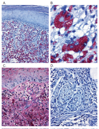 A y B. La coloraci&oacute;n de Ziehl-Neelsen muestra abundantes bacilos intracelulares, en grandes conglomerados, m&aacute;s aparentes en la superficie de la lesi&oacute;n. 20X y 100X. C. Los bacilos son tambi&eacute;n fuertemente positivos con la coloraci&oacute;n del &aacute;cido pery&oacute;dico de Schiff. 40X. D. La coloraci&oacute;n de Ziehl-Neelsen no demuestra bacilos intraneurales ni en los infiltrados profundos. 40X.