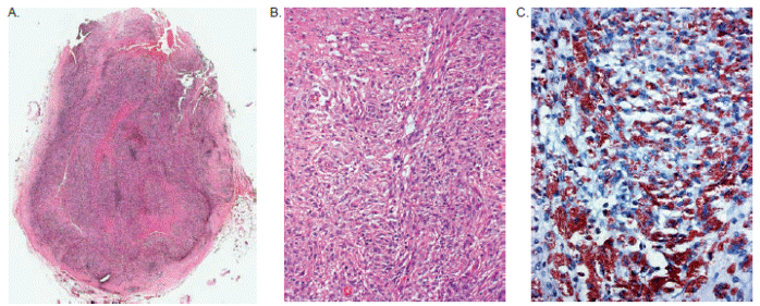 A. El ganglio linf&aacute;tico est&aacute; ampliamente reemplazado por infiltrado semejante al de la piel. Hematoxilina y eosina, 1X. B. El componente de c&eacute;lulas vacuoladas y fusiformes es prominente. Hematoxilina y eosina, 20X. C. La coloraci&oacute;n de Zielh-Neelsen demuestra un enorme n&uacute;mero de bacilos fagocitados. 20X.
