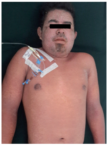 Lesiones eritematosas maculopapulares morbiliformes generalizadas y descamaci&oacute;n asociada, con edema palpebral y sin evidencia de epiderm&oacute;lisis ni presencia del signo de Nikolsky