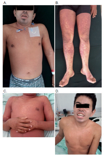 Evoluci&oacute;n cl&iacute;nica del paciente durante la hospitalizaci&oacute;n. A. Lesiones de tipo descamativo en cara durante los primeros seis d&iacute;as. B. Lesiones petequiales durante su estancia en la unidad de cuidados especiales. C-D. Disminuci&oacute;n de las lesiones descamativas y del compromiso microvascularde la dermis, y resoluci&oacute;n del cuadro cl&iacute;nico inicial.