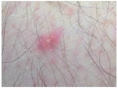 A 5 mm erythematous papule with white scaling in the center