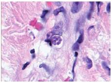 Skin histology from the lower limb showing T. gondii tachyzoites forming a pseudocyst. Giemsa stain, 40X.