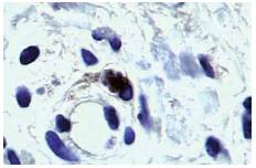 immunohistochemical staining for toxoplasma from the skin biopsy showing a pseudocyst. Toxoplasma RB9423-P rabbit monoclonalantibodies (Thermo (r) ) were used.