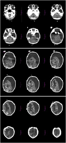 Cortes axiales de tomograf&iacute;a axial computadorizada craneal. Se observa una gran atrofia de ambos hemisferios cerebrales, con importante disminuci&oacute;n de su volumen, el cual aparece reducido a peque&ntilde;as &aacute;reas en las cuales se logr&oacute; apreciar algo de sustancia blanca con m&uacute;ltiples calcificaciones a su alrededor y desarrollo de grandes higromas qu&iacute;sticos que ocupaban la mayor&iacute;a de la b&oacute;veda craneana